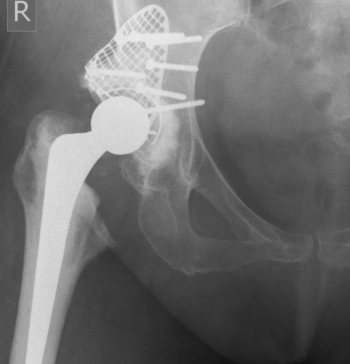 DDH THR Rim Mesh Allograft